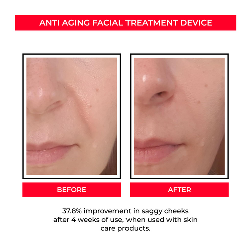 Dispositivo de rejuvenecimiento facial EMS
